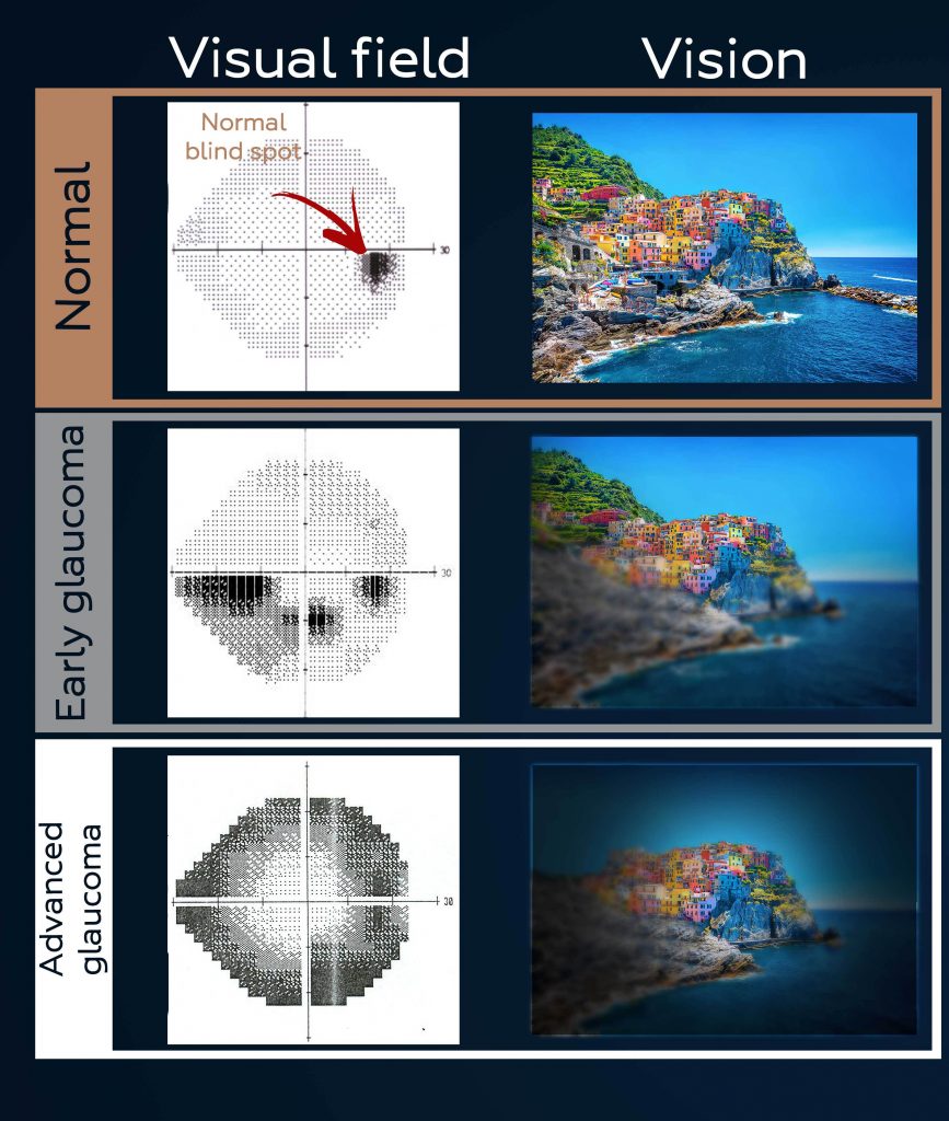 Visual field test