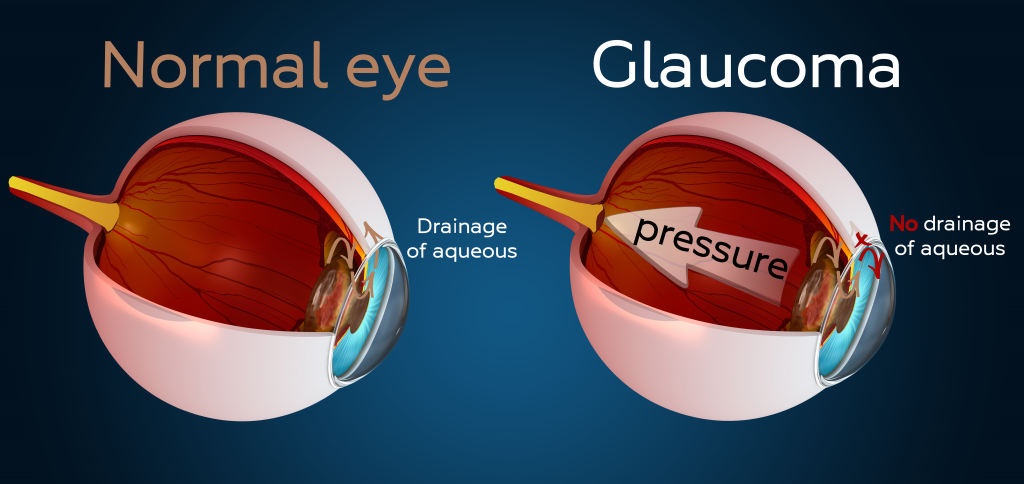Glaucoma kala motia
