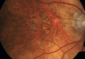 macular_degeneration
